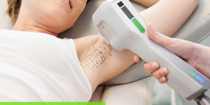 how to stop armpit sweat with miradry